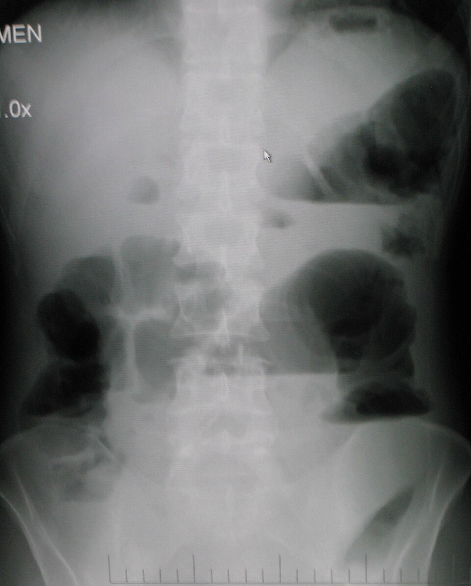AXR supine thumbnail