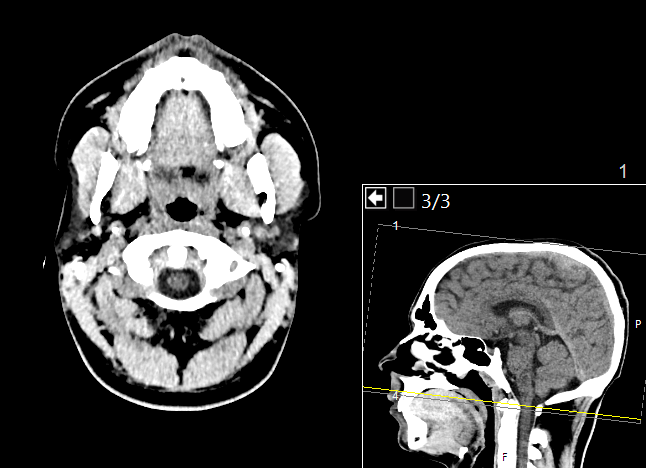 CT Head thumbnail