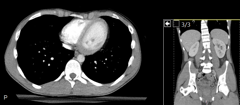 CT Abdo/Pelvis thumbnail
