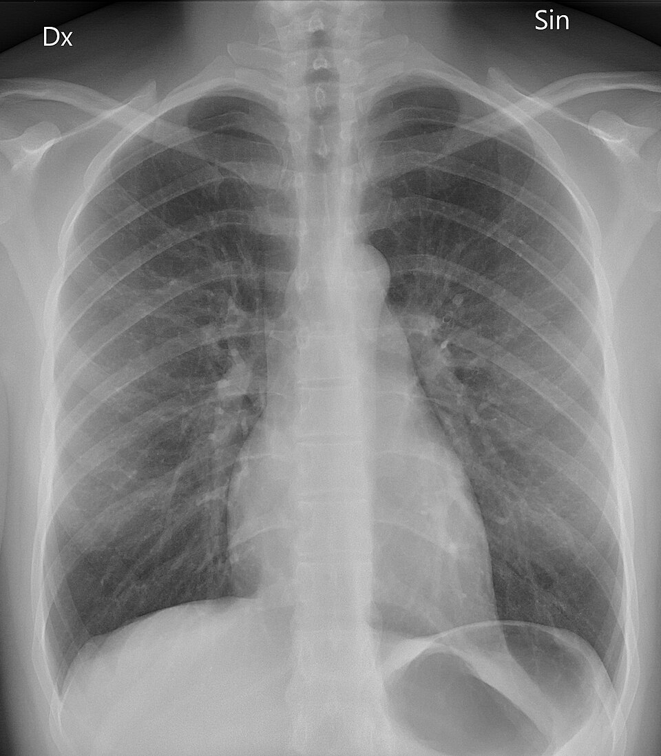 CXR PA + lateral thumbnail