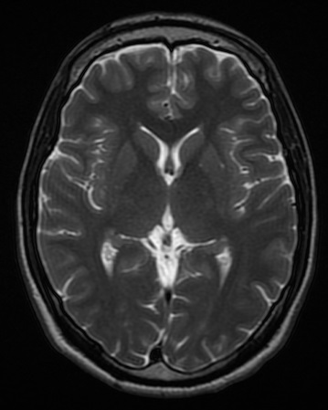 MRI Brain thumbnail