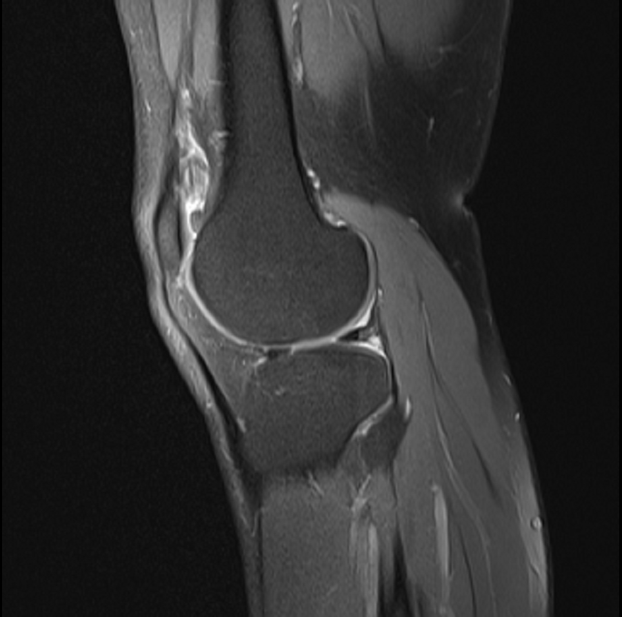 MRI Right Knee thumbnail