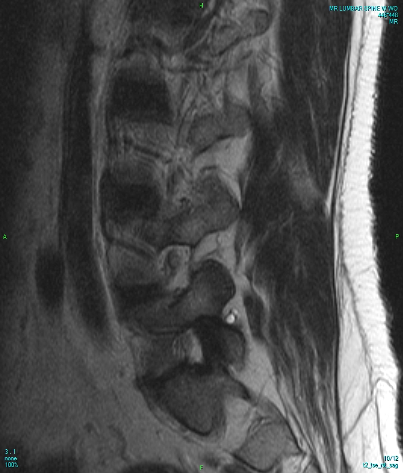 MRI L-Spine thumbnail