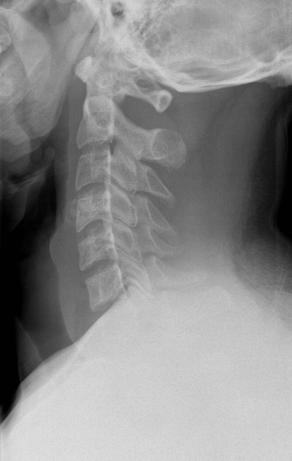 XR C-Spine thumbnail