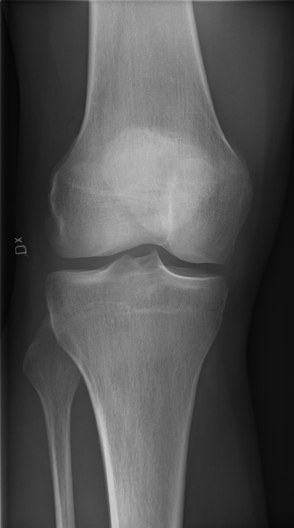 XR Right Knee thumbnail