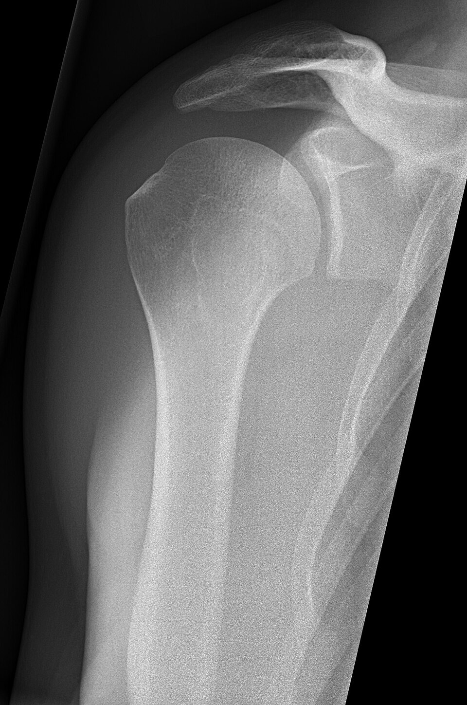 XR Left Shoulder thumbnail