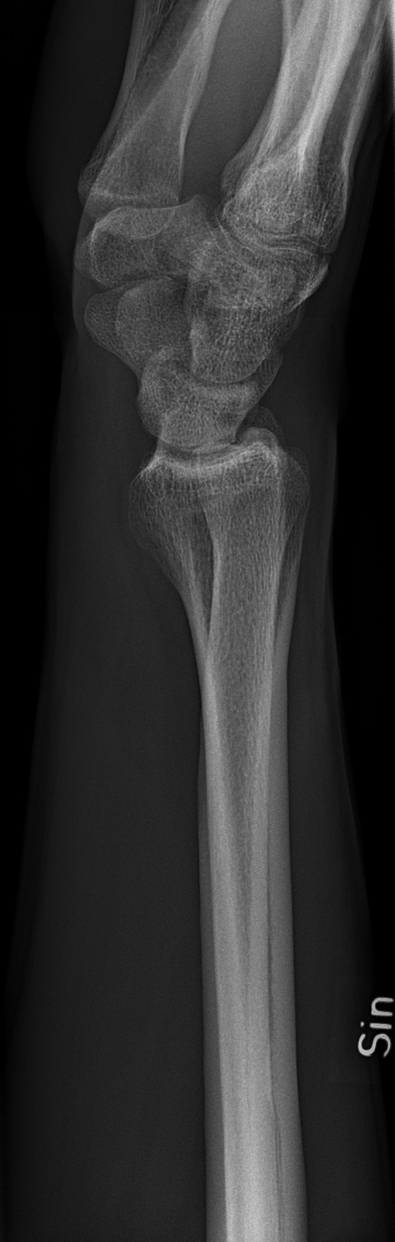 XR Left Wrist thumbnail